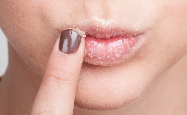 10 Best And Effective Ways To Cure Chapped Lips