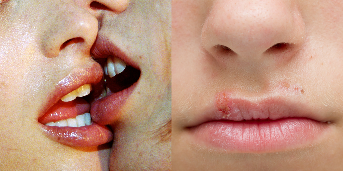 5 Diseases And Infections You Can Get From Kissing