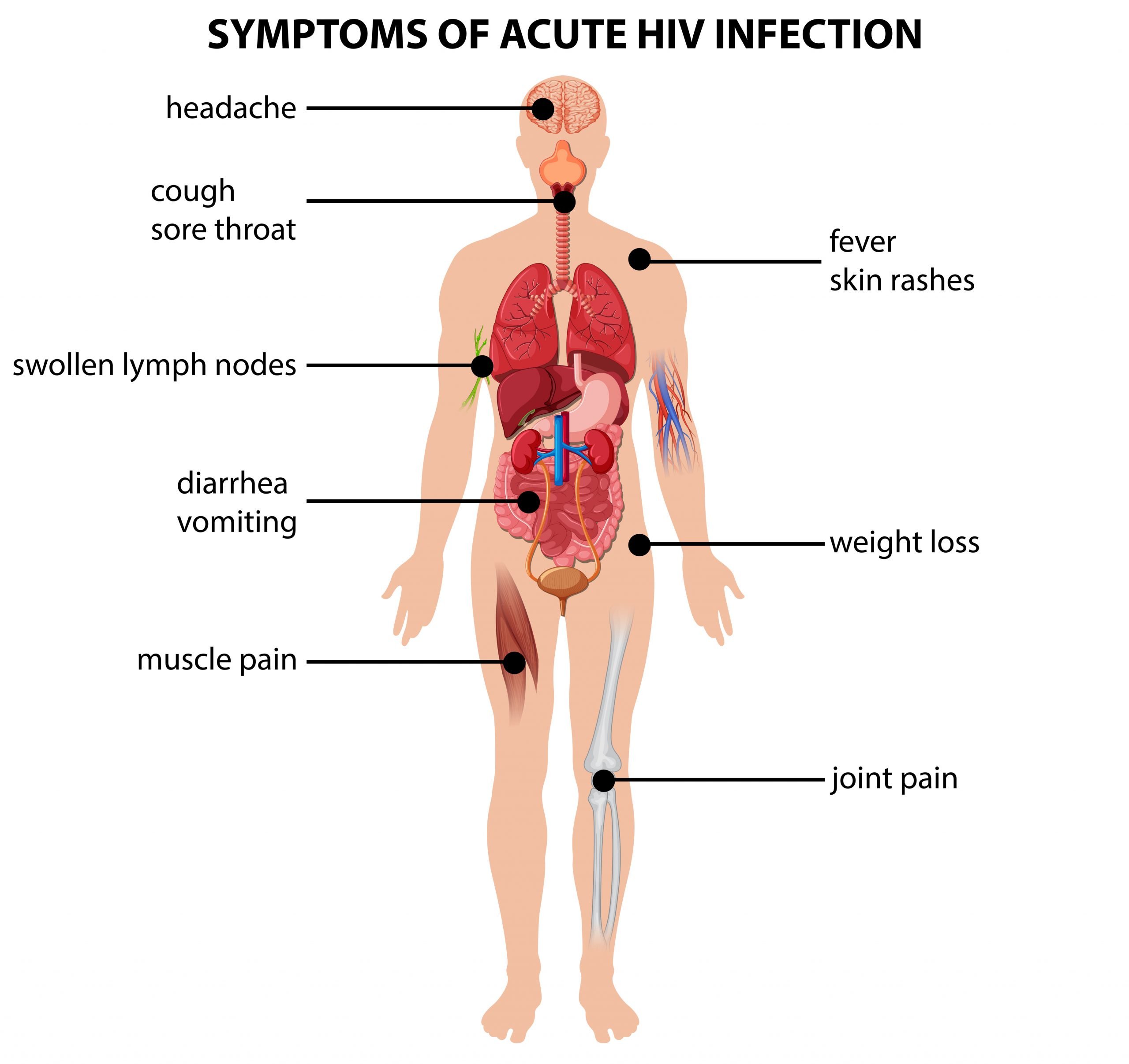 Diagram showing symptoms of acute HIV infection 417700 ...