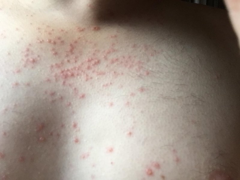 Does this look like an HIV rash?. Thread discussing Does ...