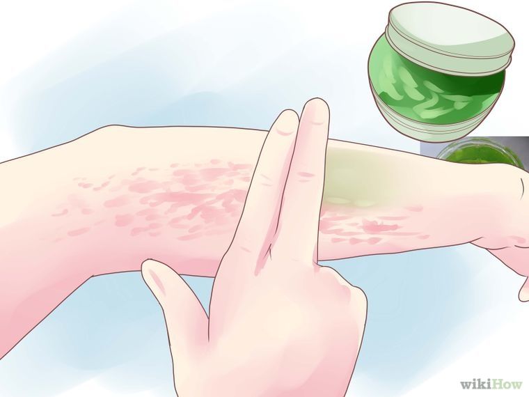 Get Rid of Hives