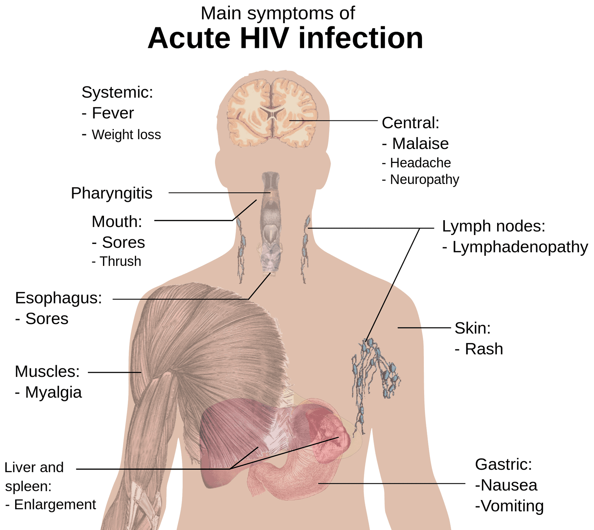 HIV infection symptoms â MOBIEG