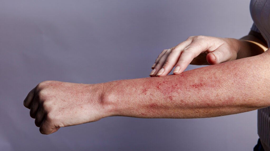 HIV rash: Types, causes, other symptoms, when to see a doctor