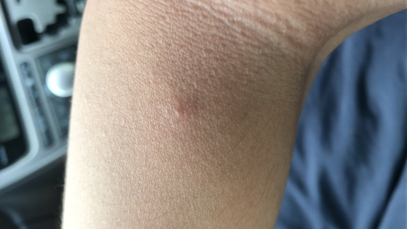 HIV skin rash?