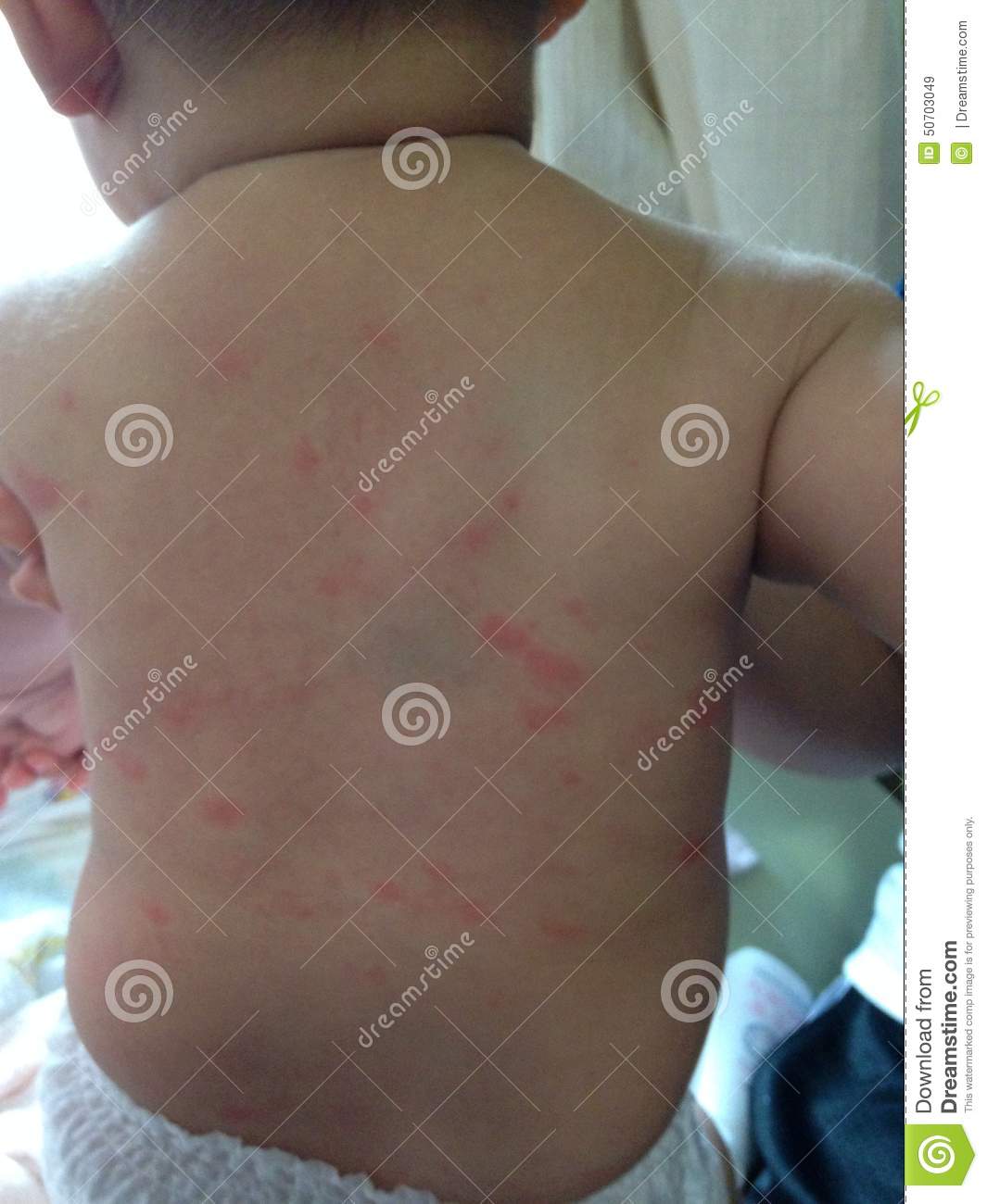 Hives On Baby Stomach / Rash On Baby Stomach Identification