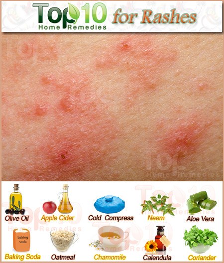 Home Remedies for Rashes