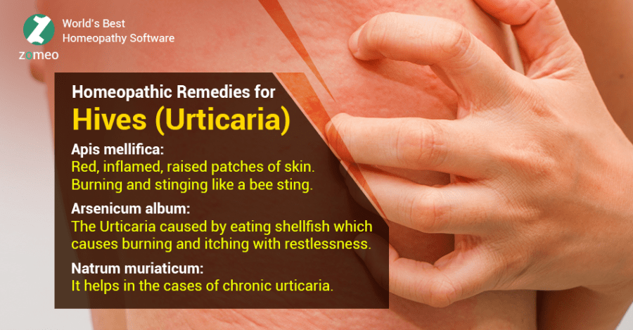Homeopathic Remedies for Hives (Urticaria)