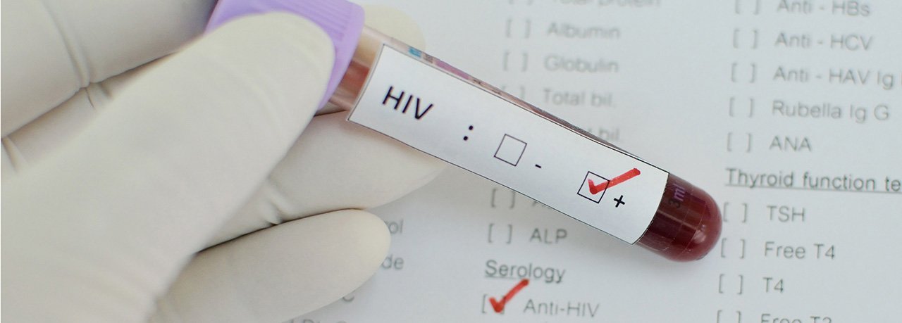 How Do I Know If I Have HIV Positive