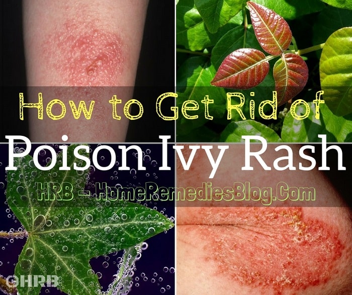 How to Get Rid of Poison Ivy Rash: 14 Fast Home Remedies