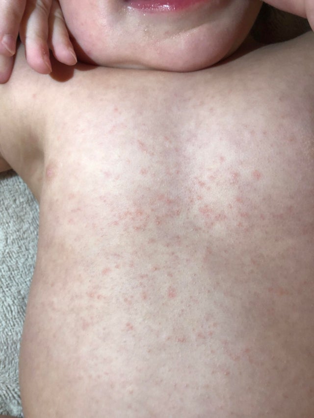 Is this a roseola rash? Had fever that lasted two days and reached 104. ...
