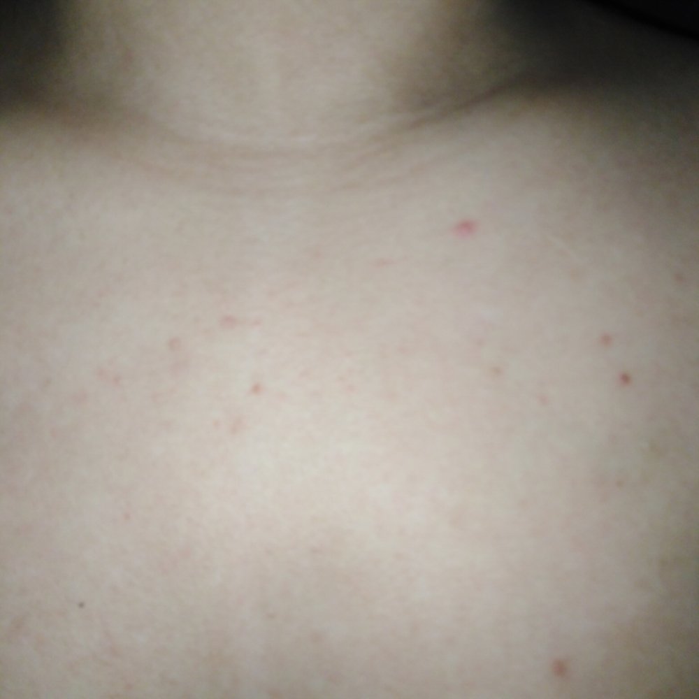 Is this hiv rash or just a a acne