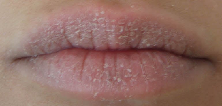 Lip Infections and Their Cure : Human N Health