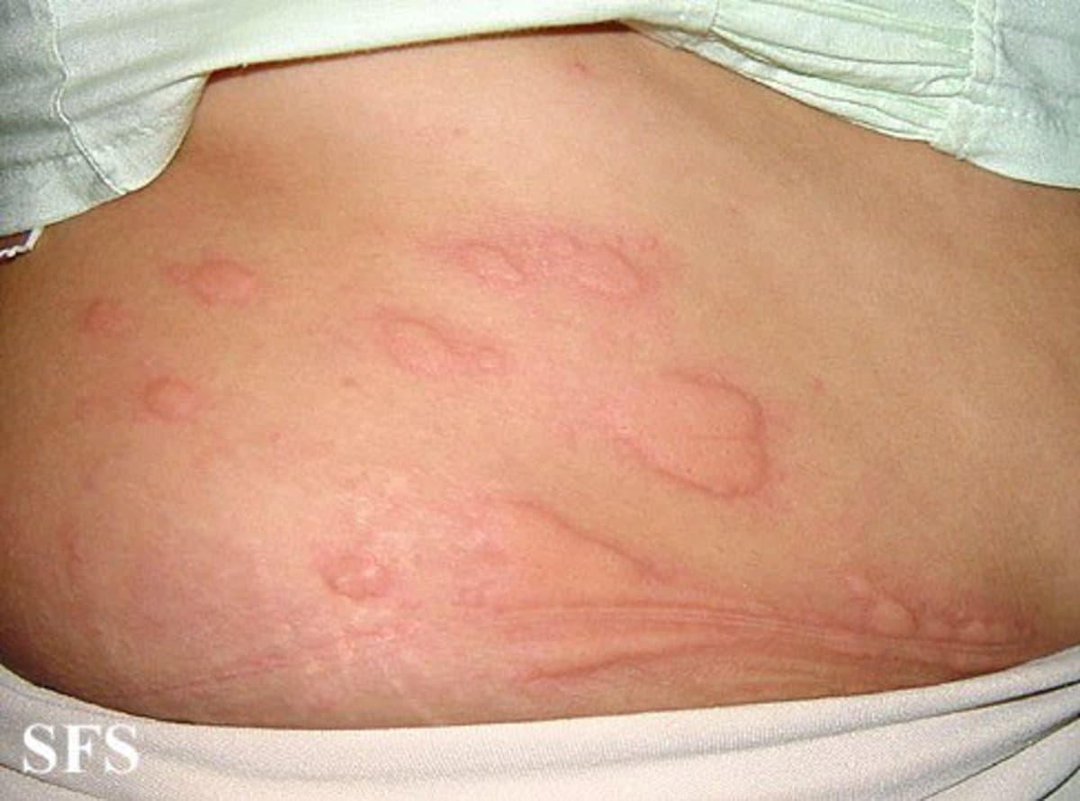 List of Itchy Rashes
