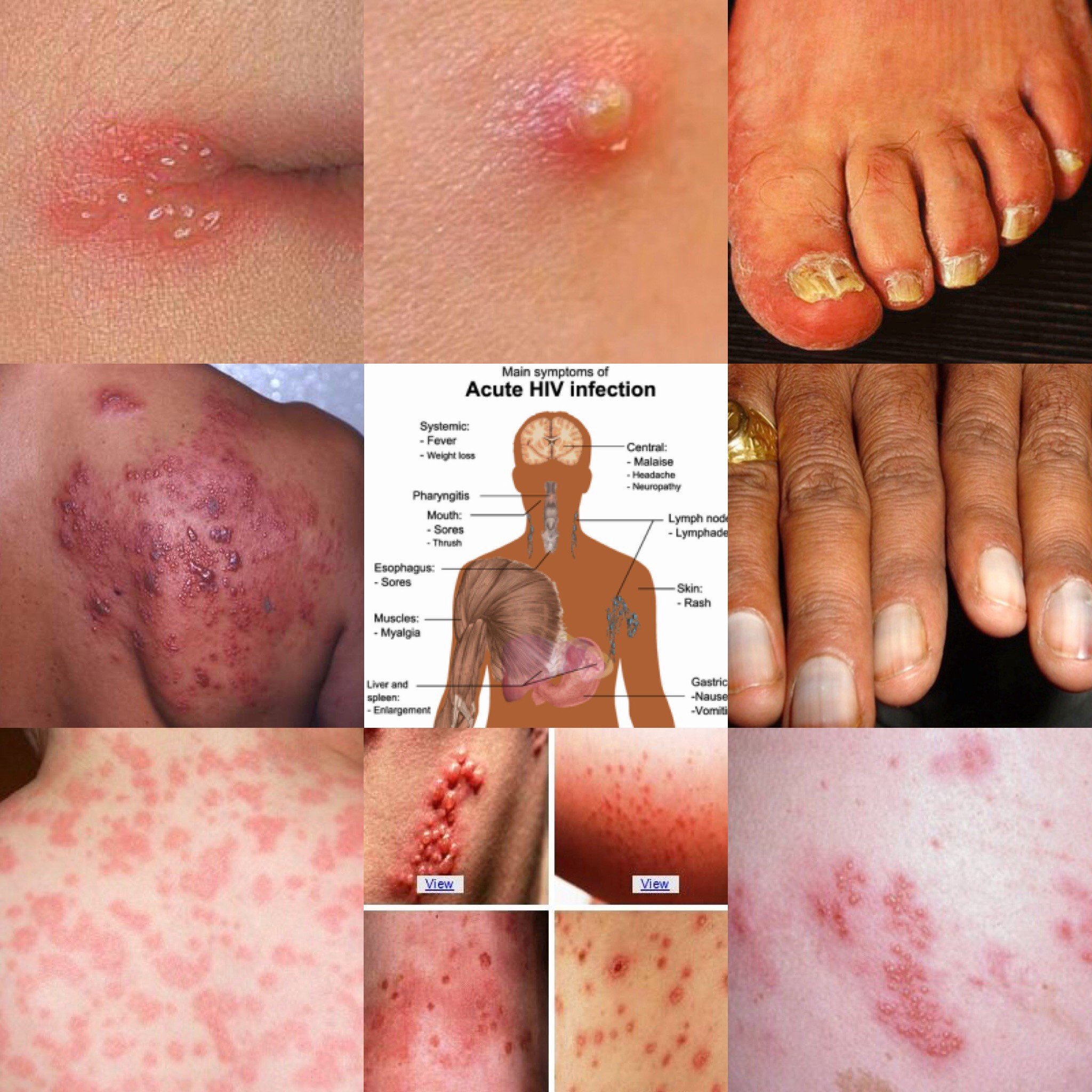 ONE OF HIV SYMPTOMS IS RASH. A VERY IMPORTANT ARTICLE TO READ