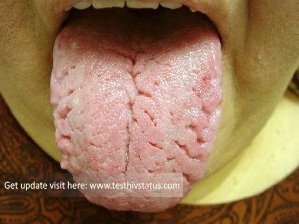 Pin by Hafiza Alam on HIV Symptoms Tongue