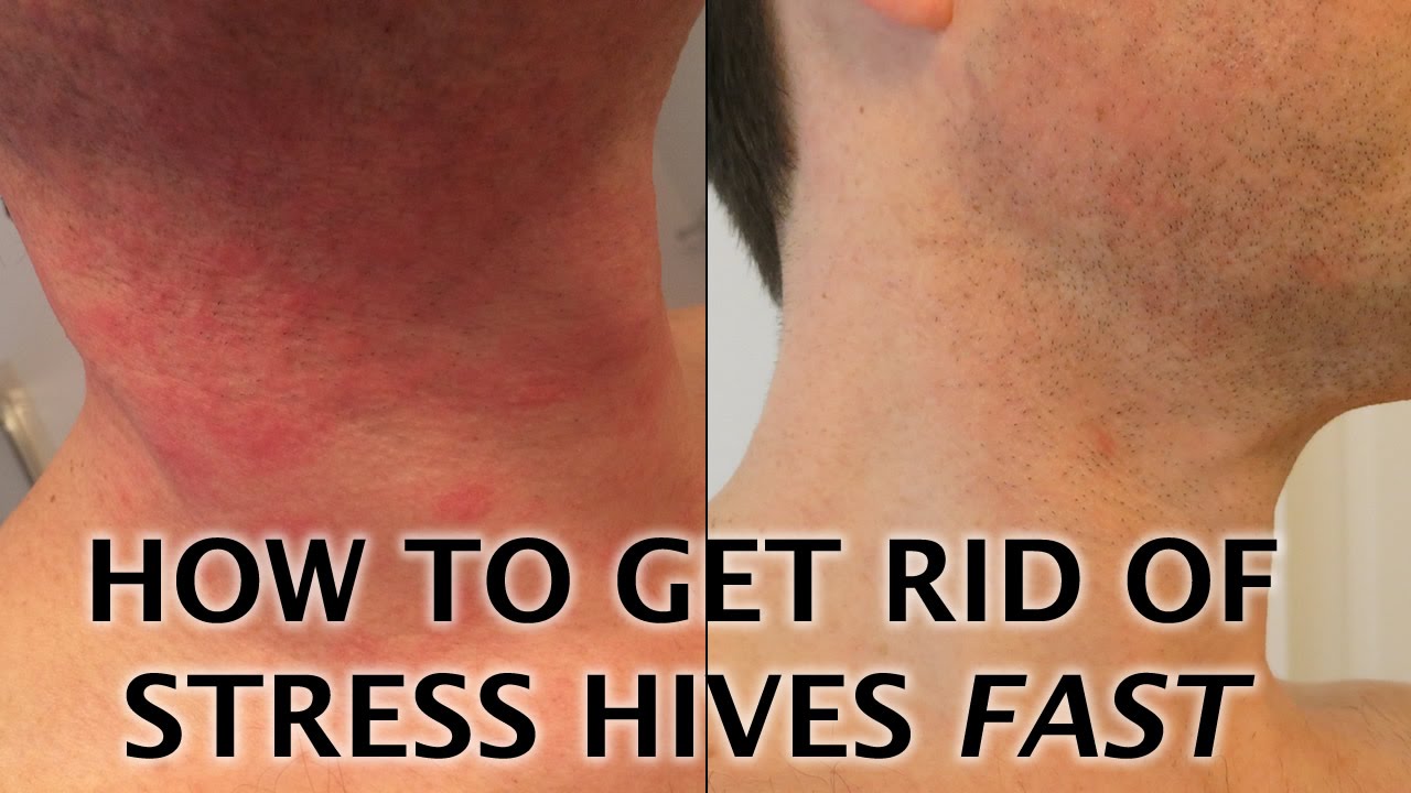 rashes caused by stress
