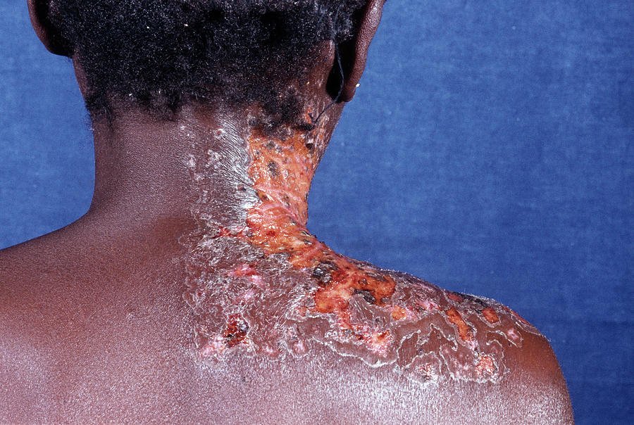 Shingles Rash In An Aids Patient Photograph by Dr M.a. Ansary/science ...