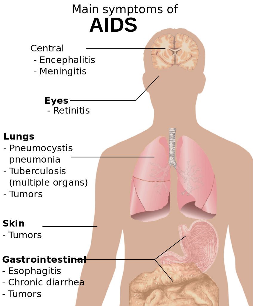 Symptoms of AIDS » Science and Technology News Site