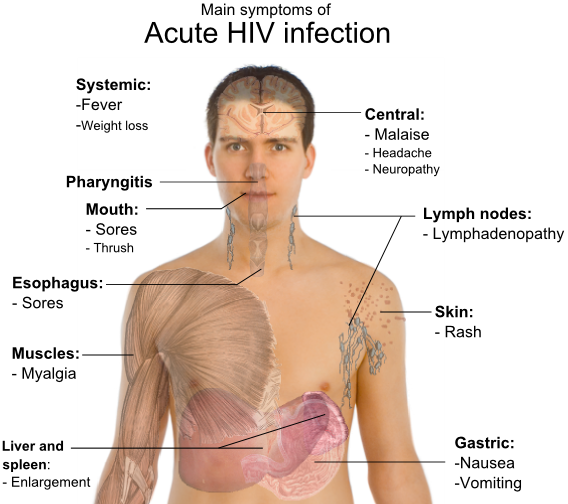Symptoms of HIV