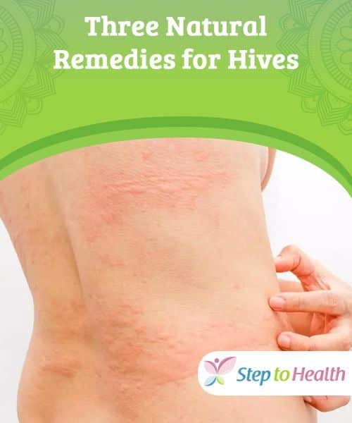 Three Natural Remedies for Hives If you suffer from an allergic ...