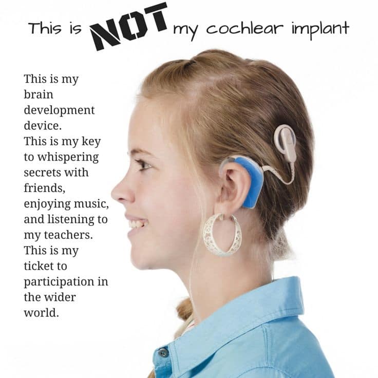 Understanding Cochlear Implants