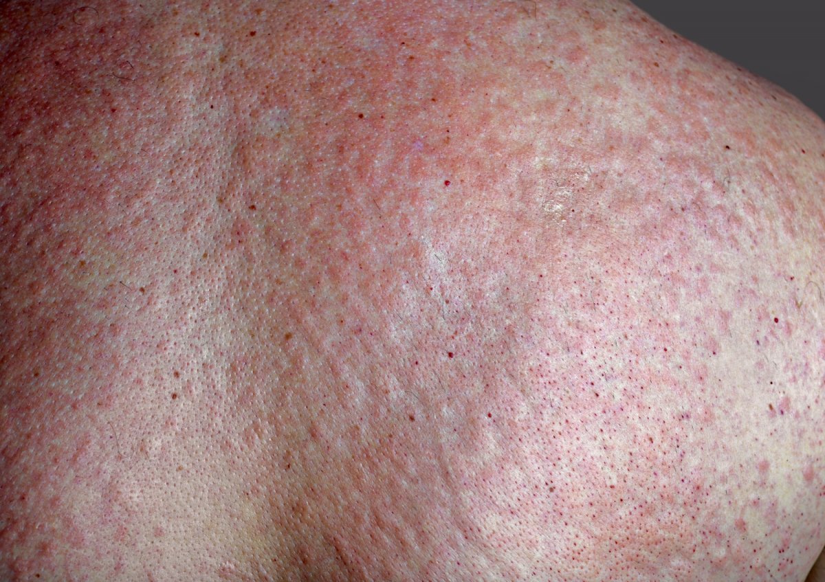 Vibratory urticarial: Rare disorder makes people break out in hives ...