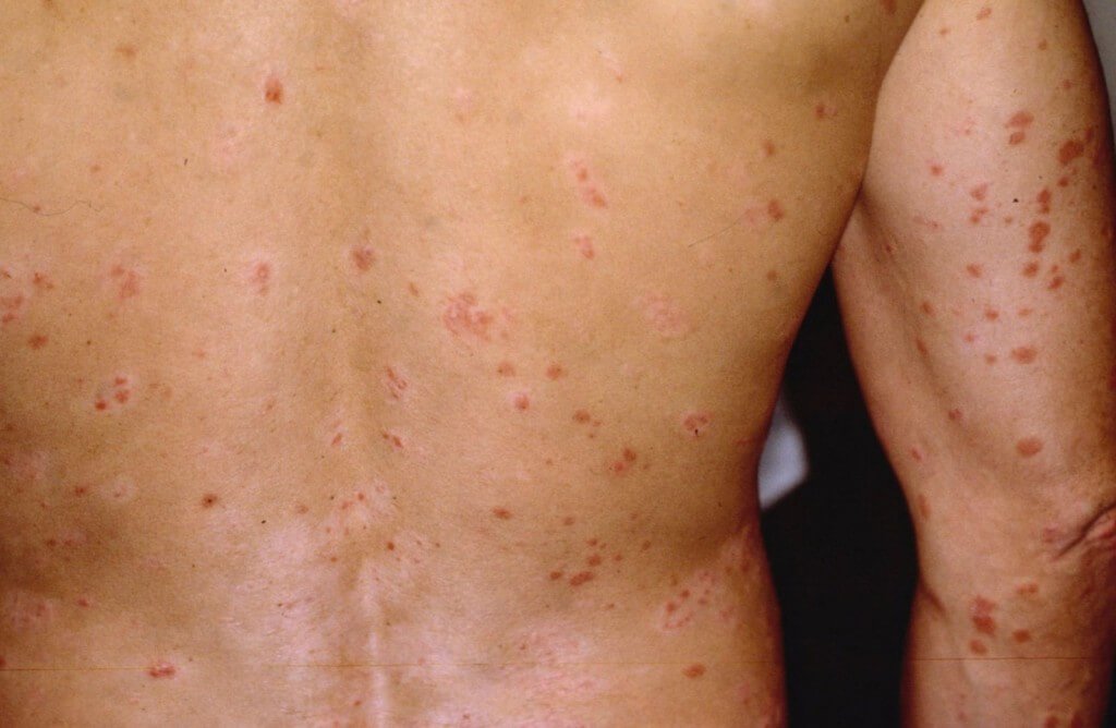 What are the symptoms of psoriases and treatment for it