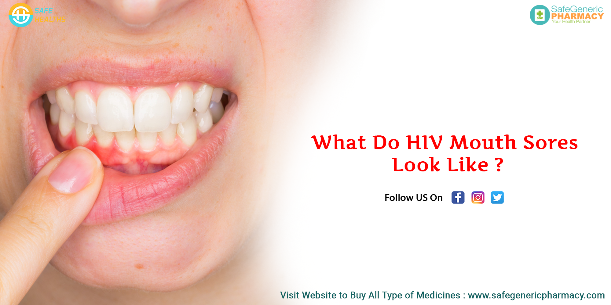 What Do HIV Mouth Sores Look Like?
