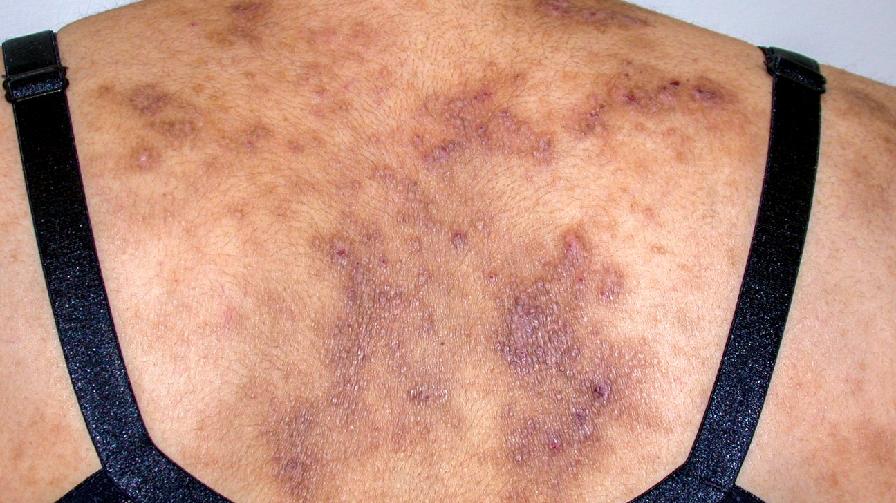 What Does HIV Rash Look Like and How to Treat it?