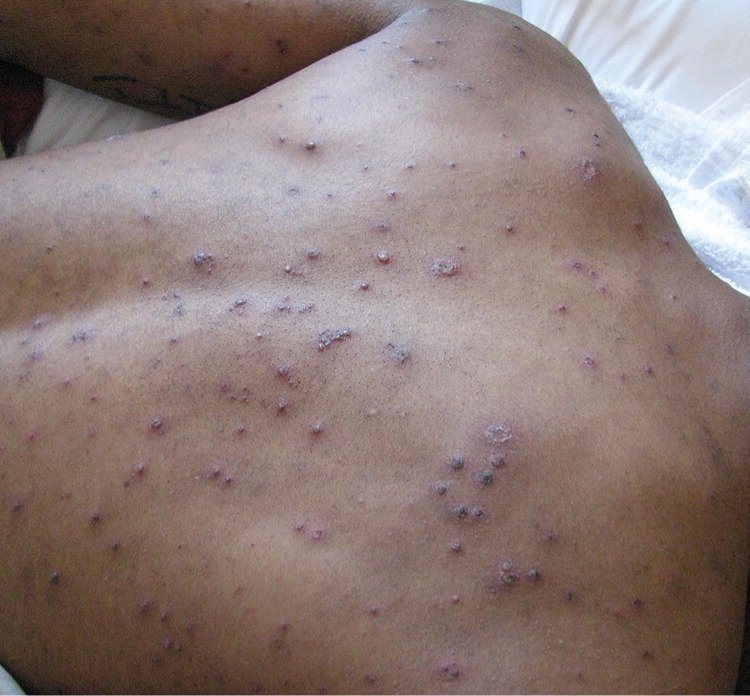 What Does HIV Rash Look Like and How to Treat it?