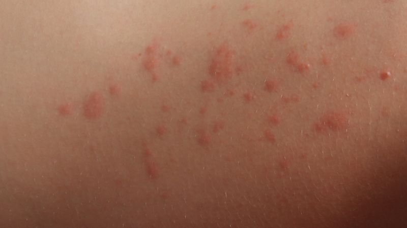 Whats that rash?: with pictures