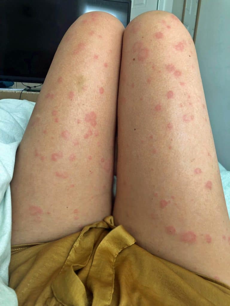 » Woman Branded contagious For Mystery Allergy That Cause Daily Hives ...